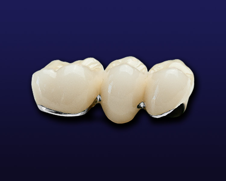 Porcelain Fused to Metal