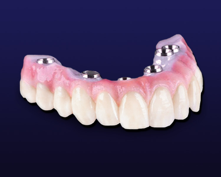 All-on-X implant dental lab