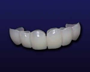 Composite/PMMA - Stoller Dental Lab