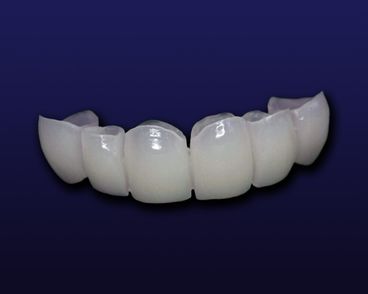 dental lab composite pmma restorations