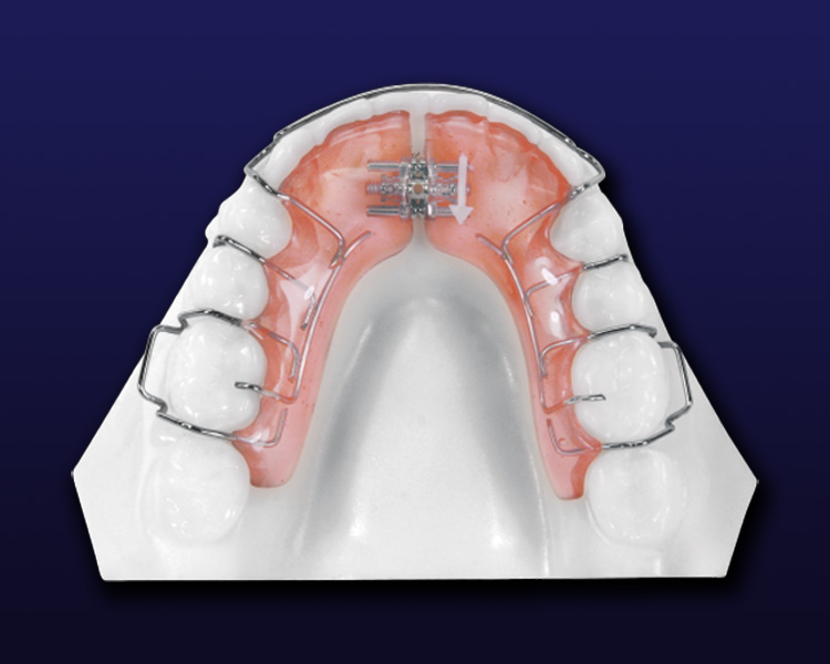 schwartz removable appliances